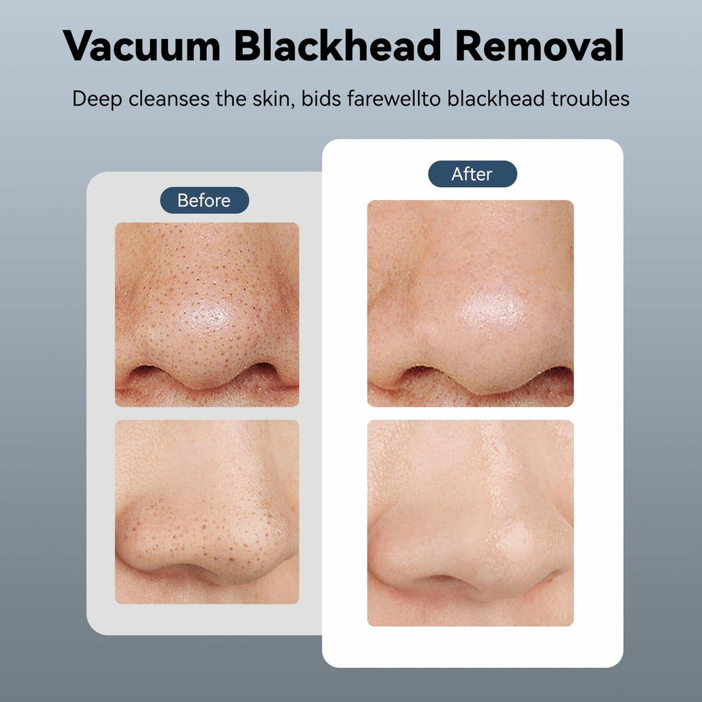 Blackhead Remover Pore Vacuum 5 in 1 Blackhead Remover Tools with Hot & Cold ...
